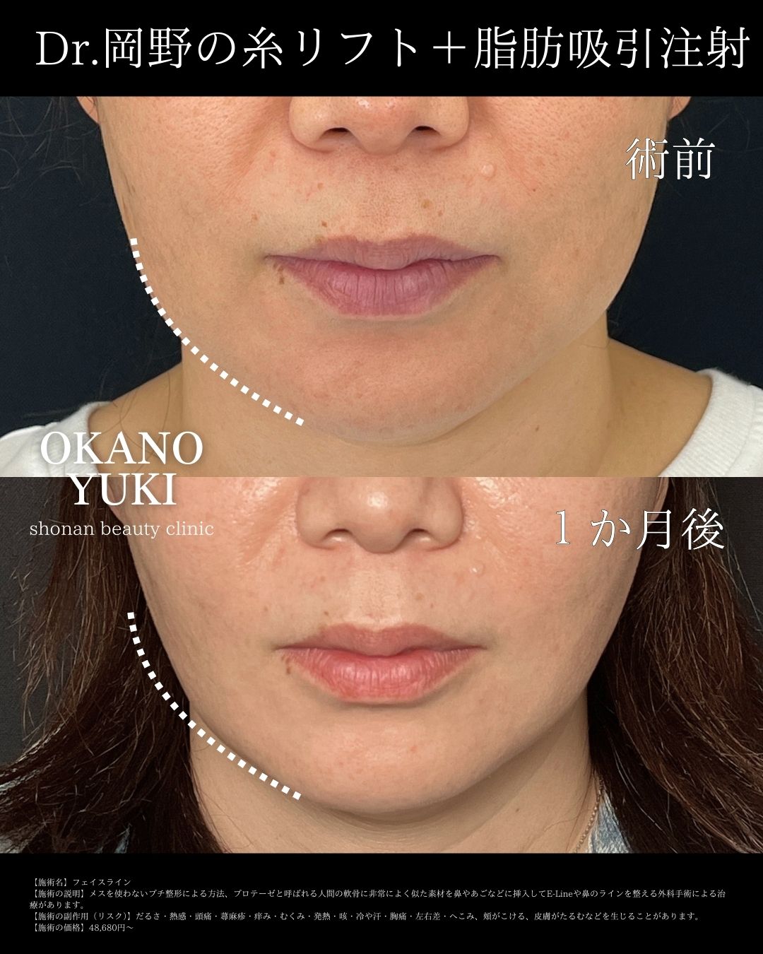 糸リフト＋脂肪吸引