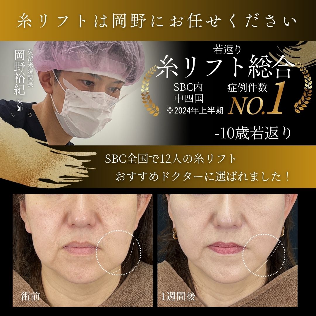 【大人気】福岡久留米で糸リフトするなら岡野裕紀院長！久留米院限定の推し活糸リフト！