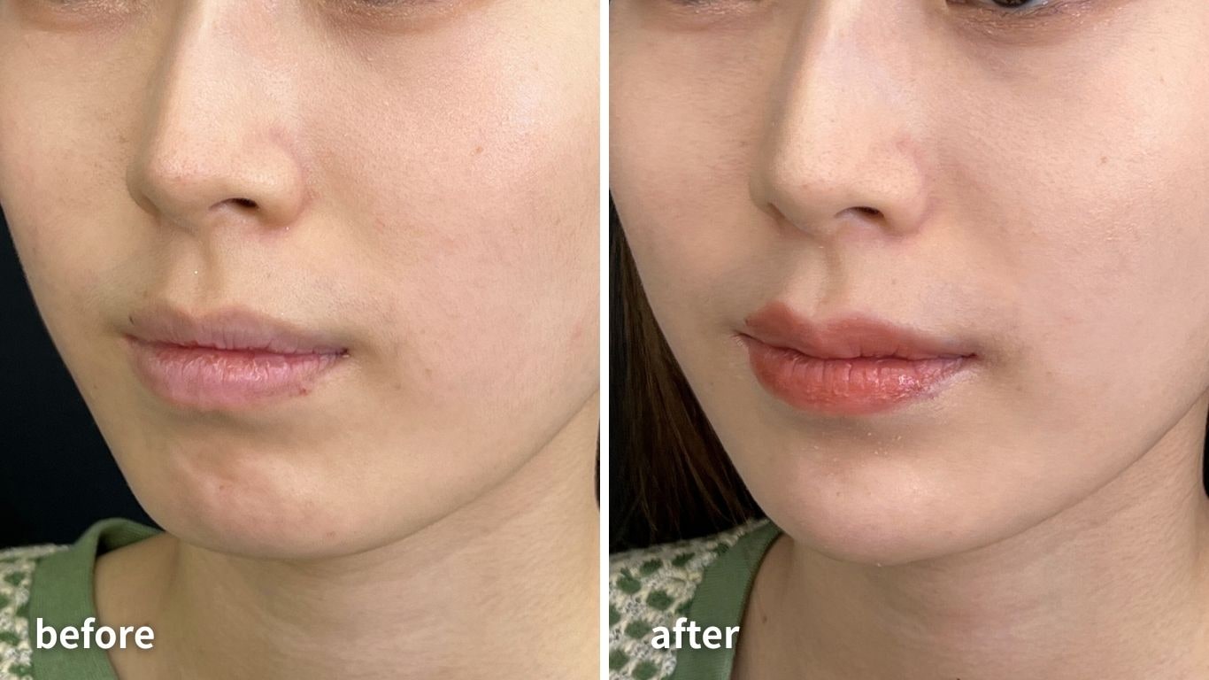 あご・フェイスライン