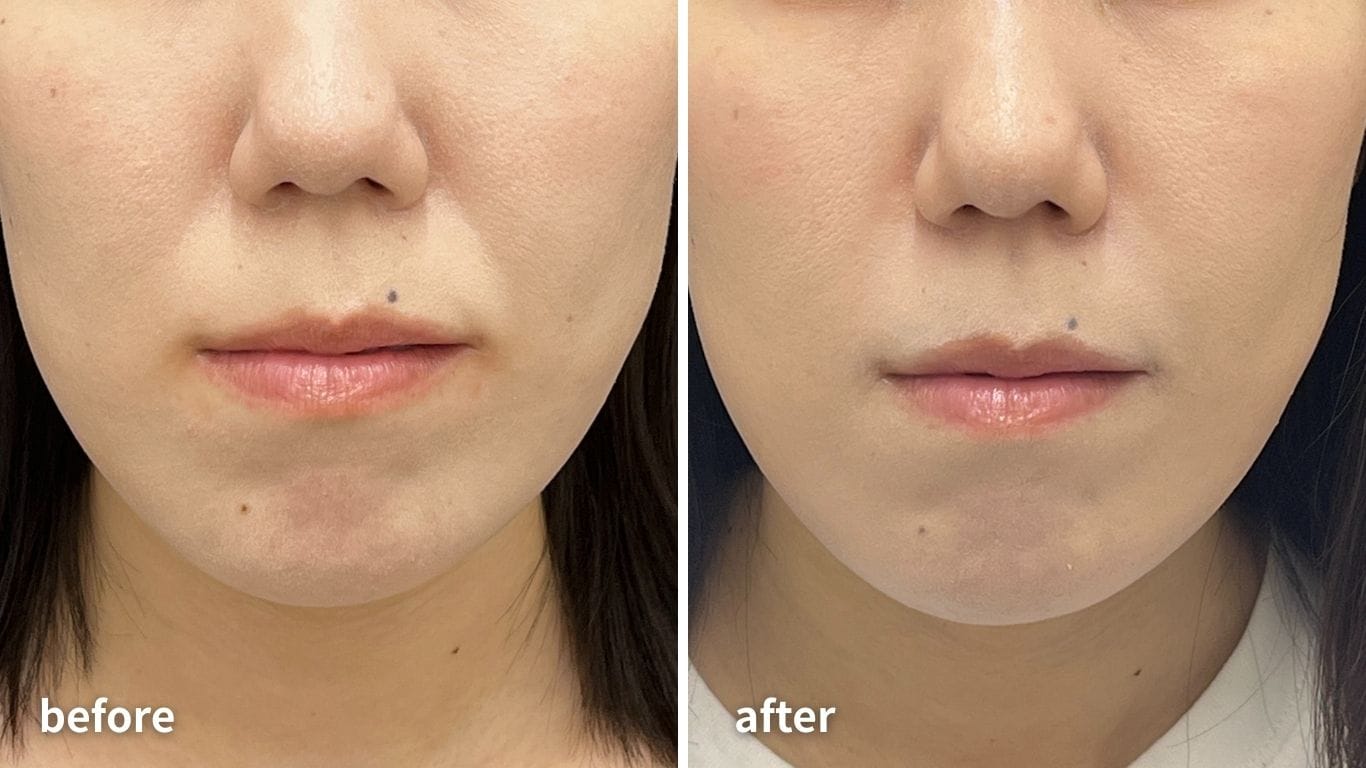 ほうれい線【2本】