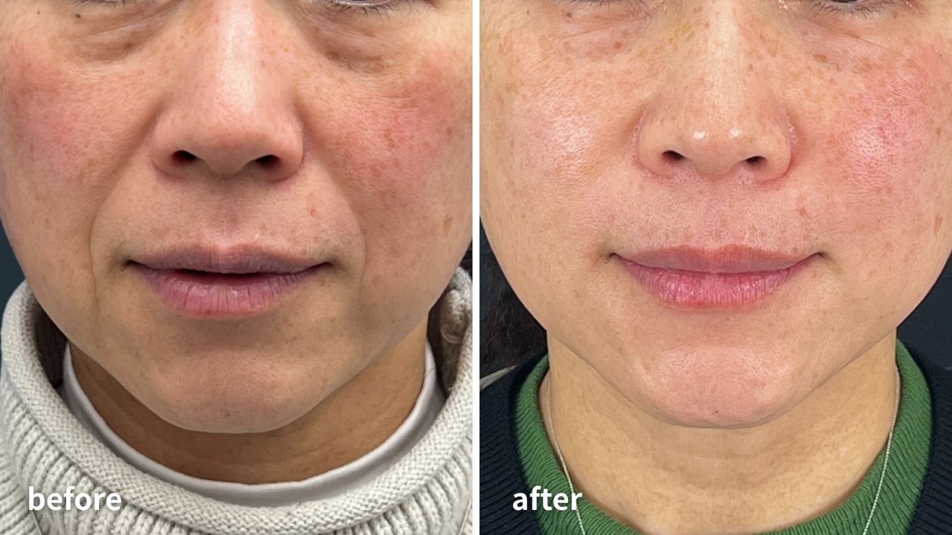 ほうれい線＋α【3本】