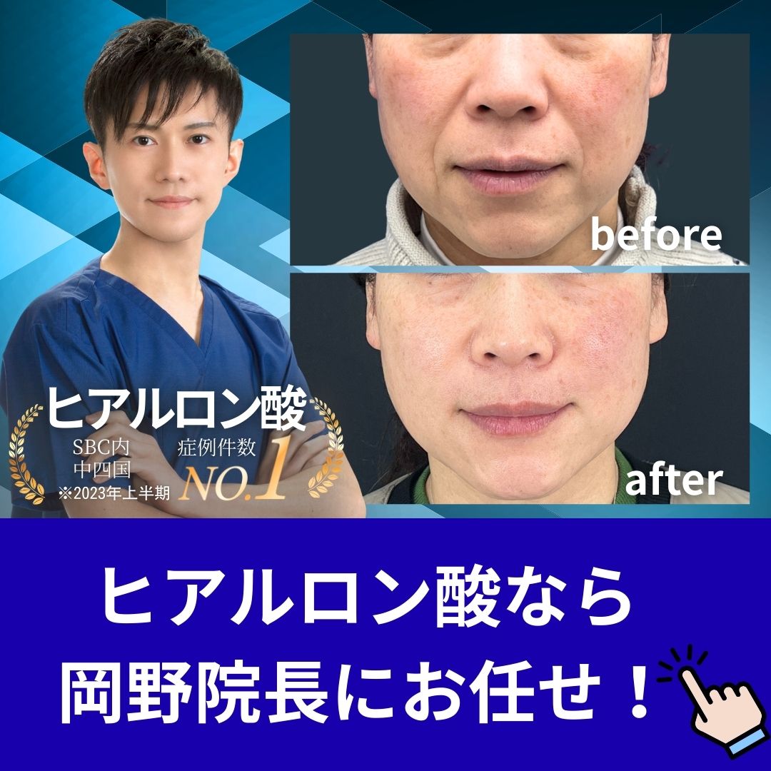 【福岡・久留米】若返るならヒアルロン酸の名医岡野院長へ|ほうれい線もゴルゴ線も即日解消!