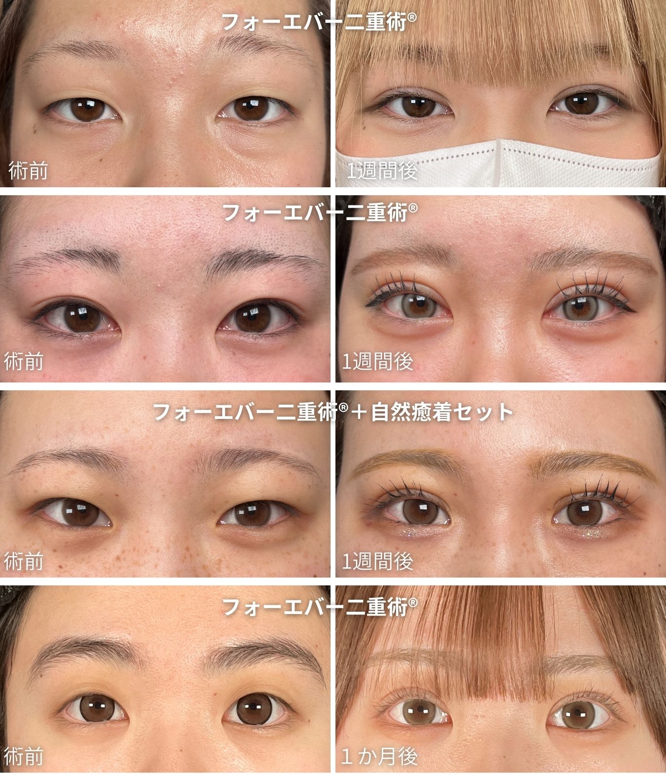フォーエバー二重術®