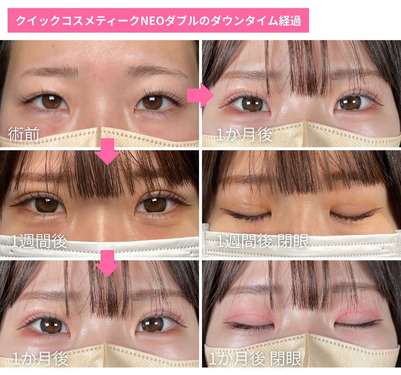 ダウンタイム経過📸