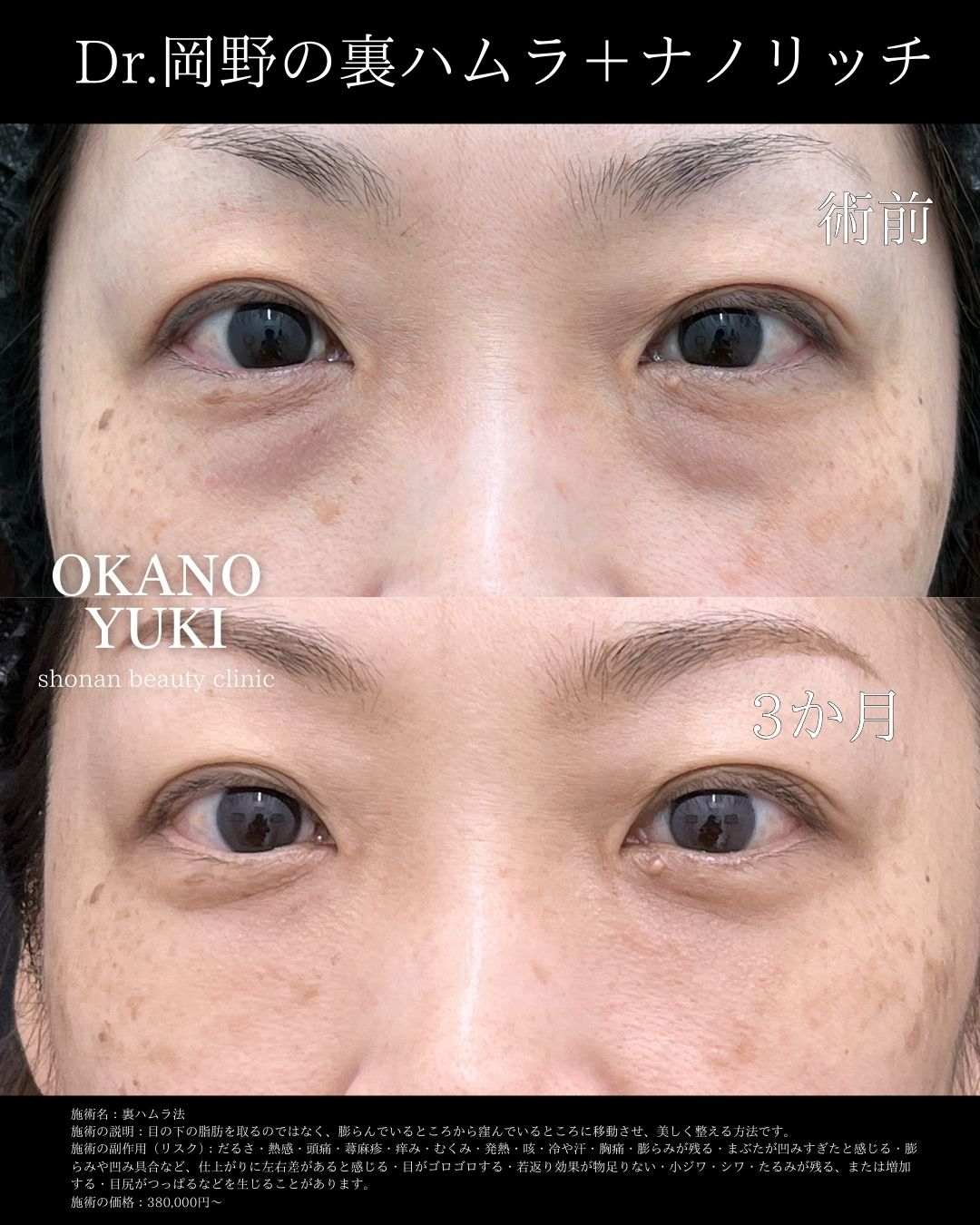 「裏ハムラ＋ナノリッチ」