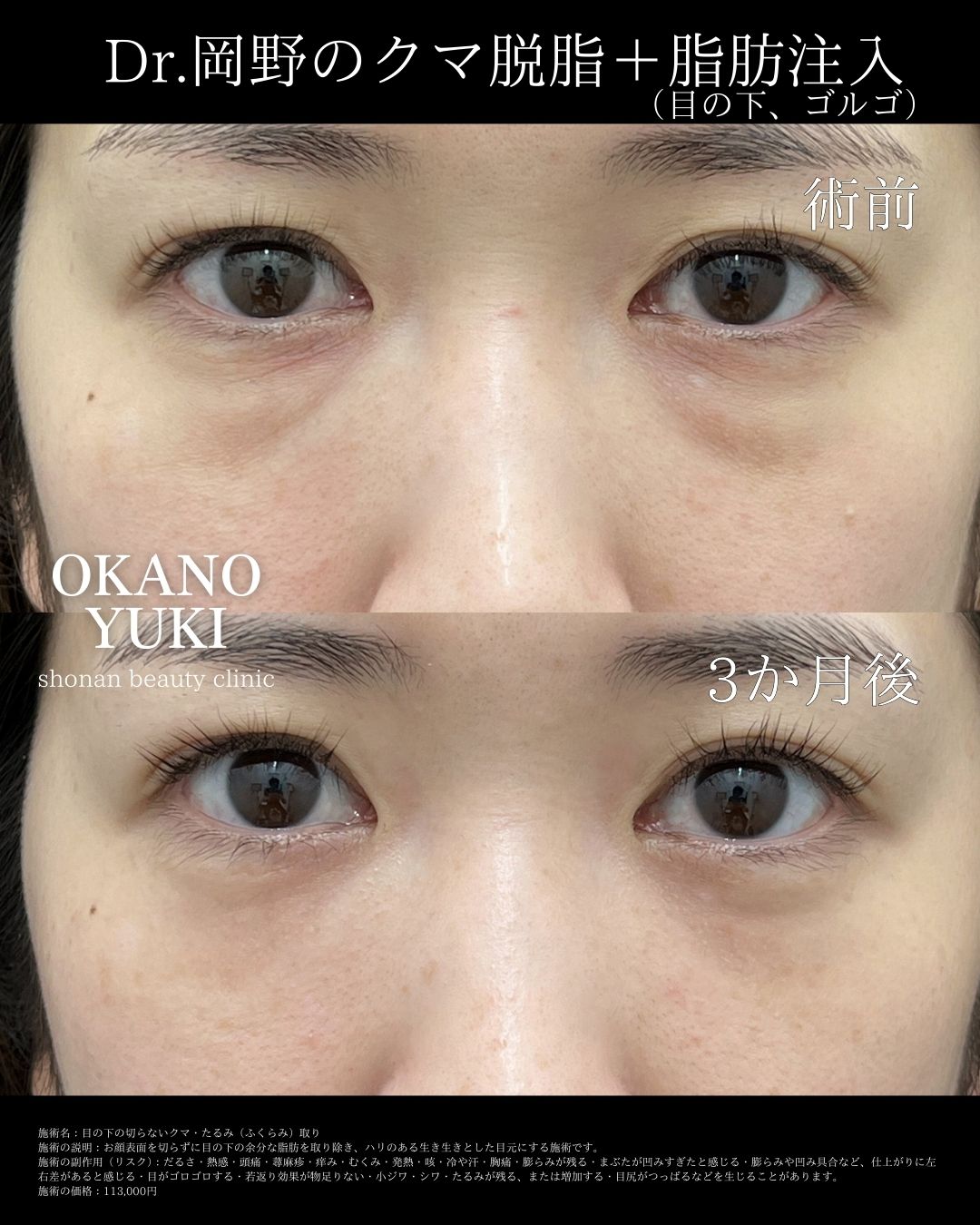 「目の下切らないクマ・たるみ取り＋ナノリッチ(脂肪注入)」