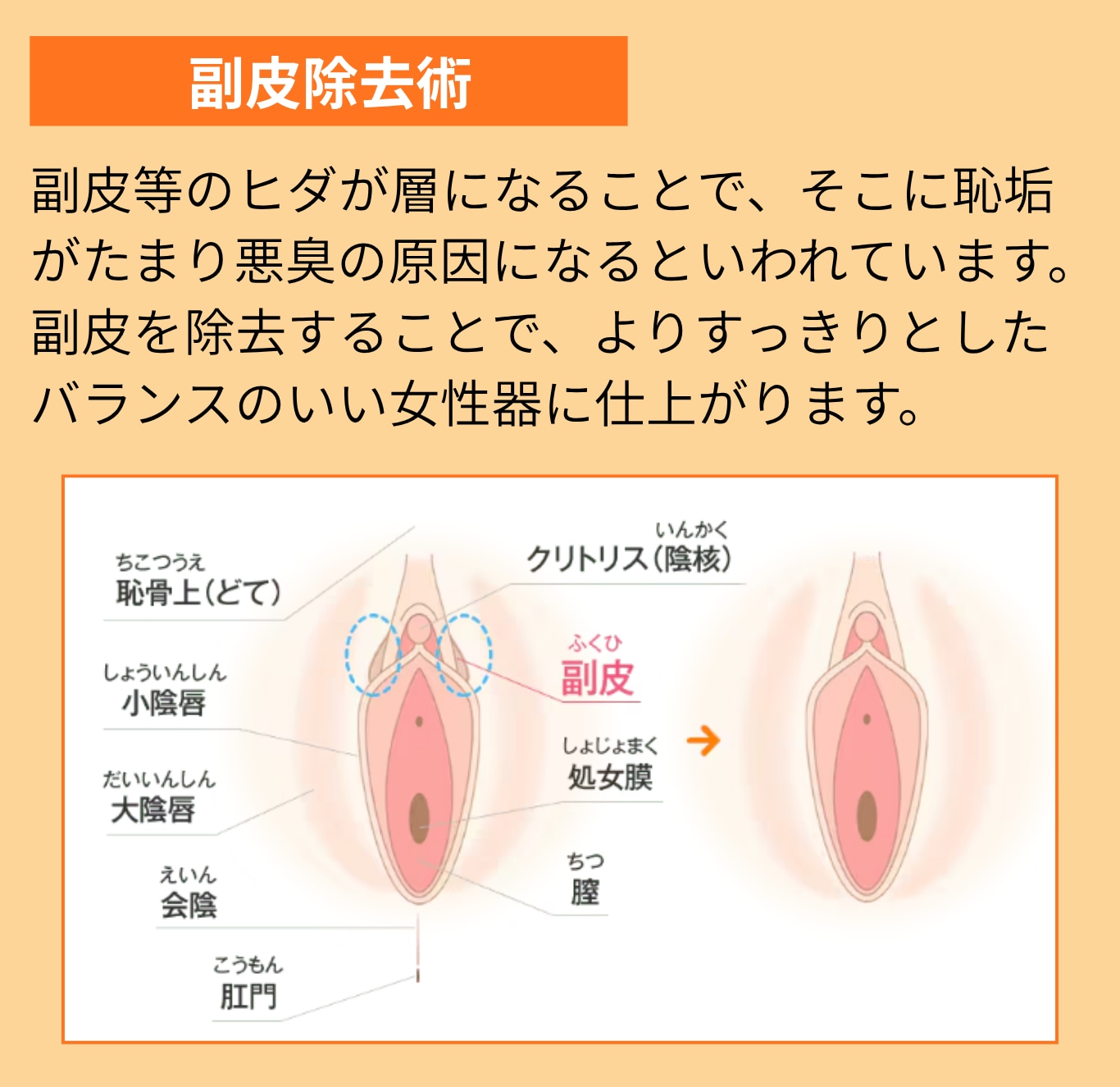 副皮除去術とは？