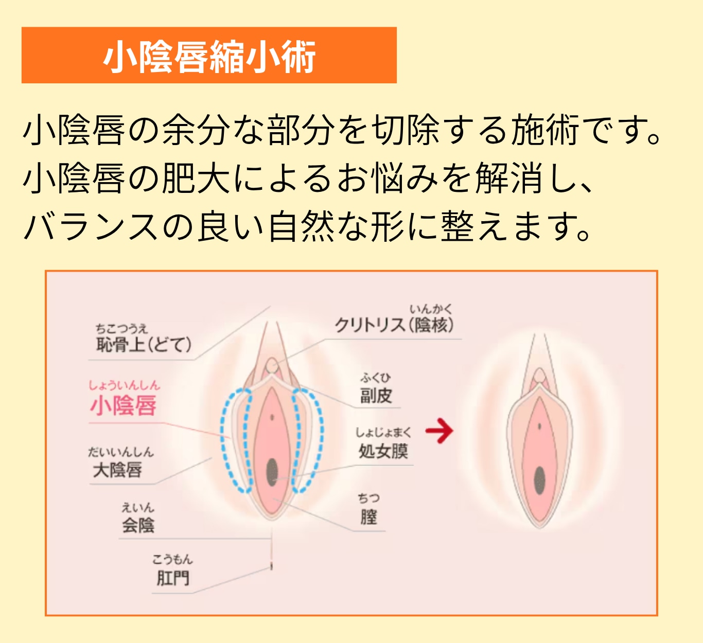 小陰唇縮小術とは？