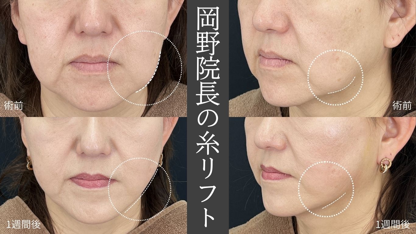 SBC全国糸リフトおすすめドクターの技術！✨