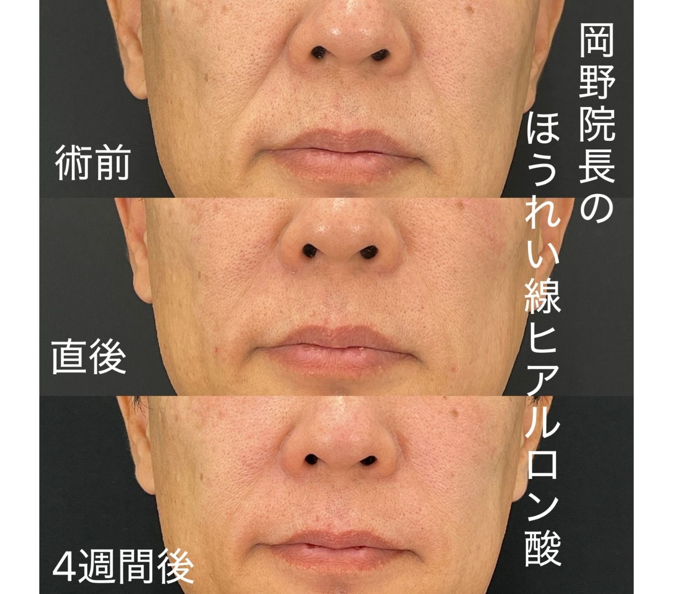 ヒアルロン酸のダウンタイム経過