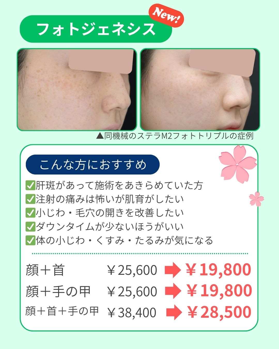 レーザーで肌育✨