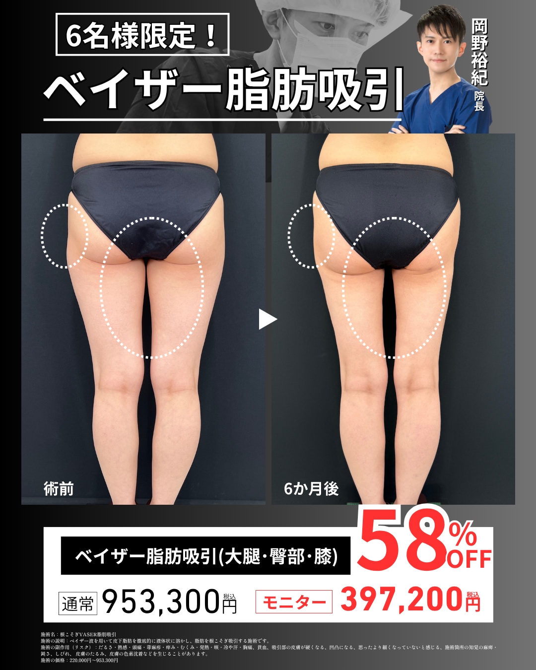 脂肪吸引