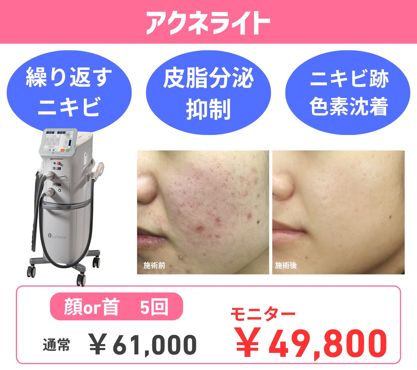 繰り返すニキビ根本解決！