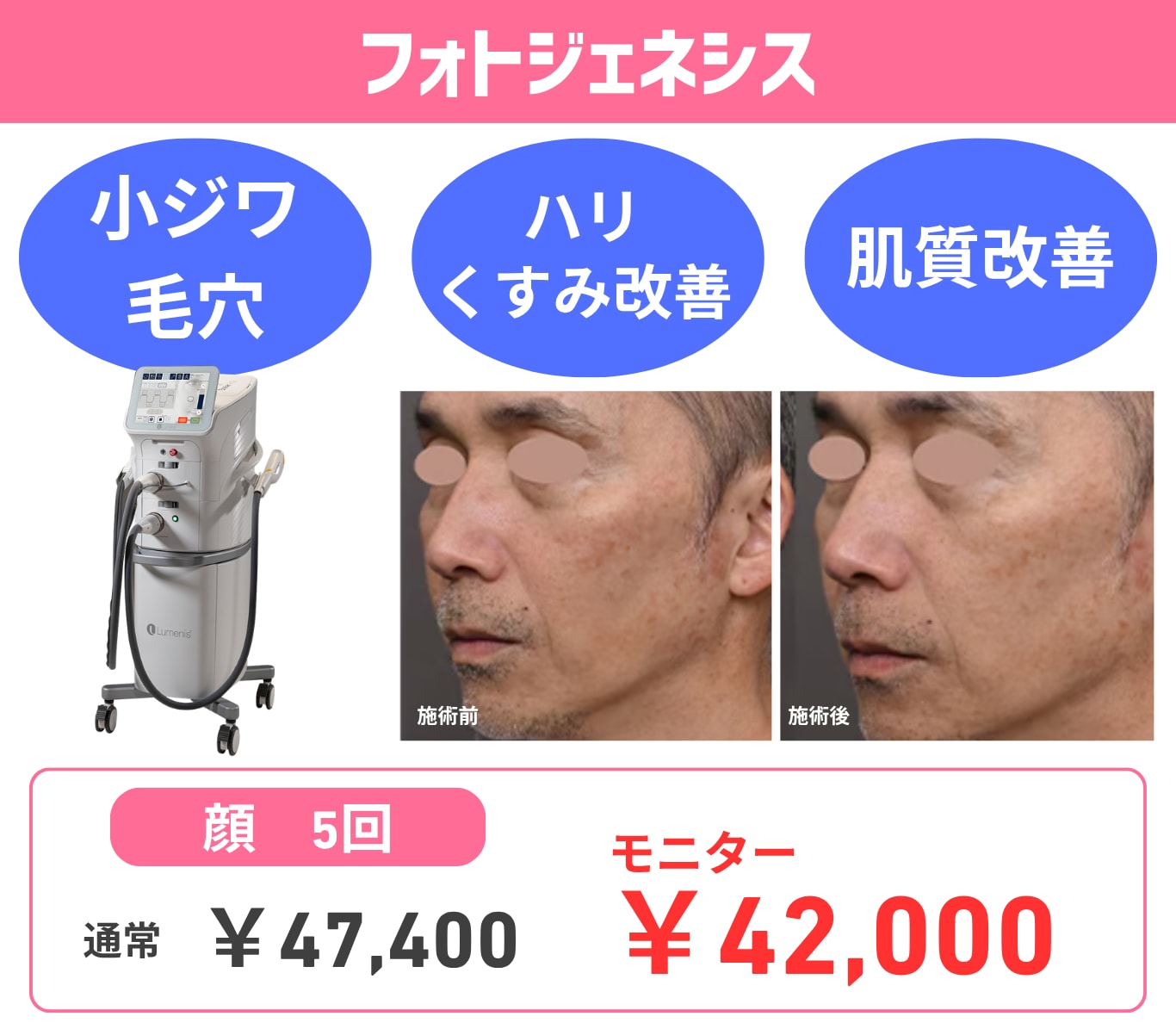 光治療で肌質改善！