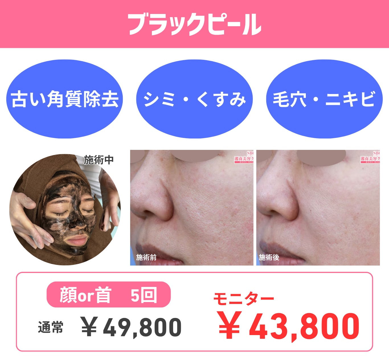 活性炭を用いたアンチエイジング