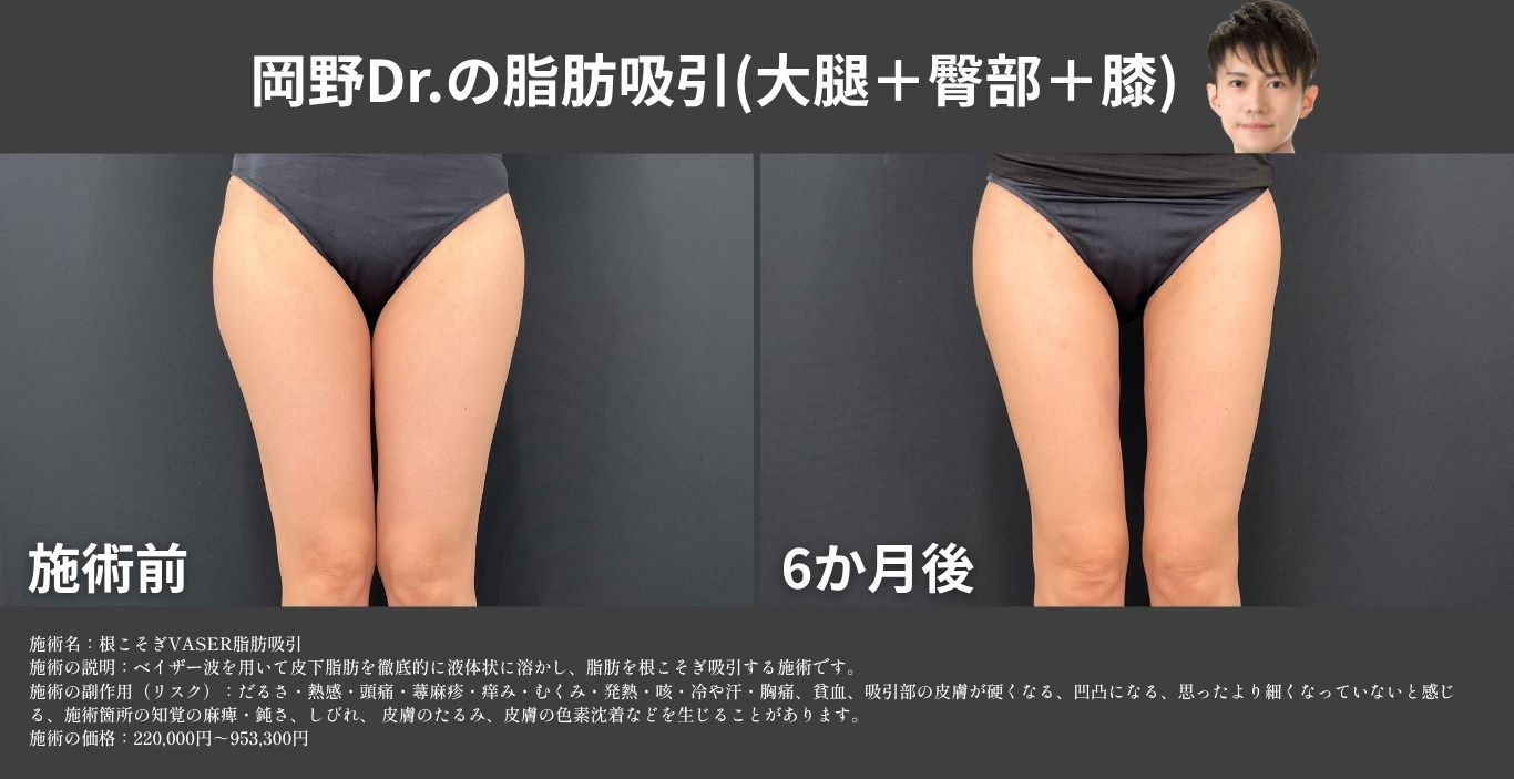 内もも・大腿全面のベイザー脂肪吸引の症例写真 湘南美容クリニック久留米院