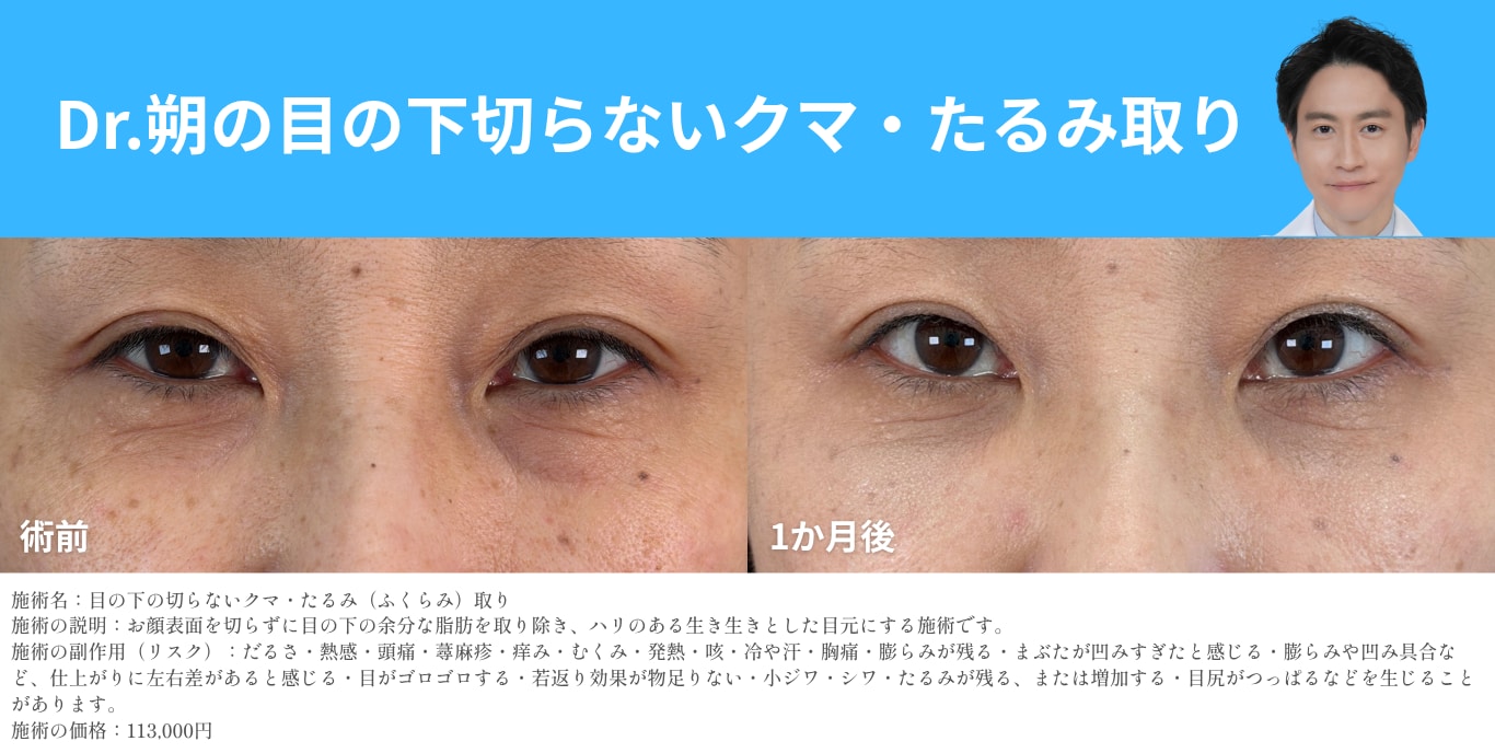 目の下切らないクマ・たるみ取りの症例写真 湘南美容クリニック久留米院 朔医師