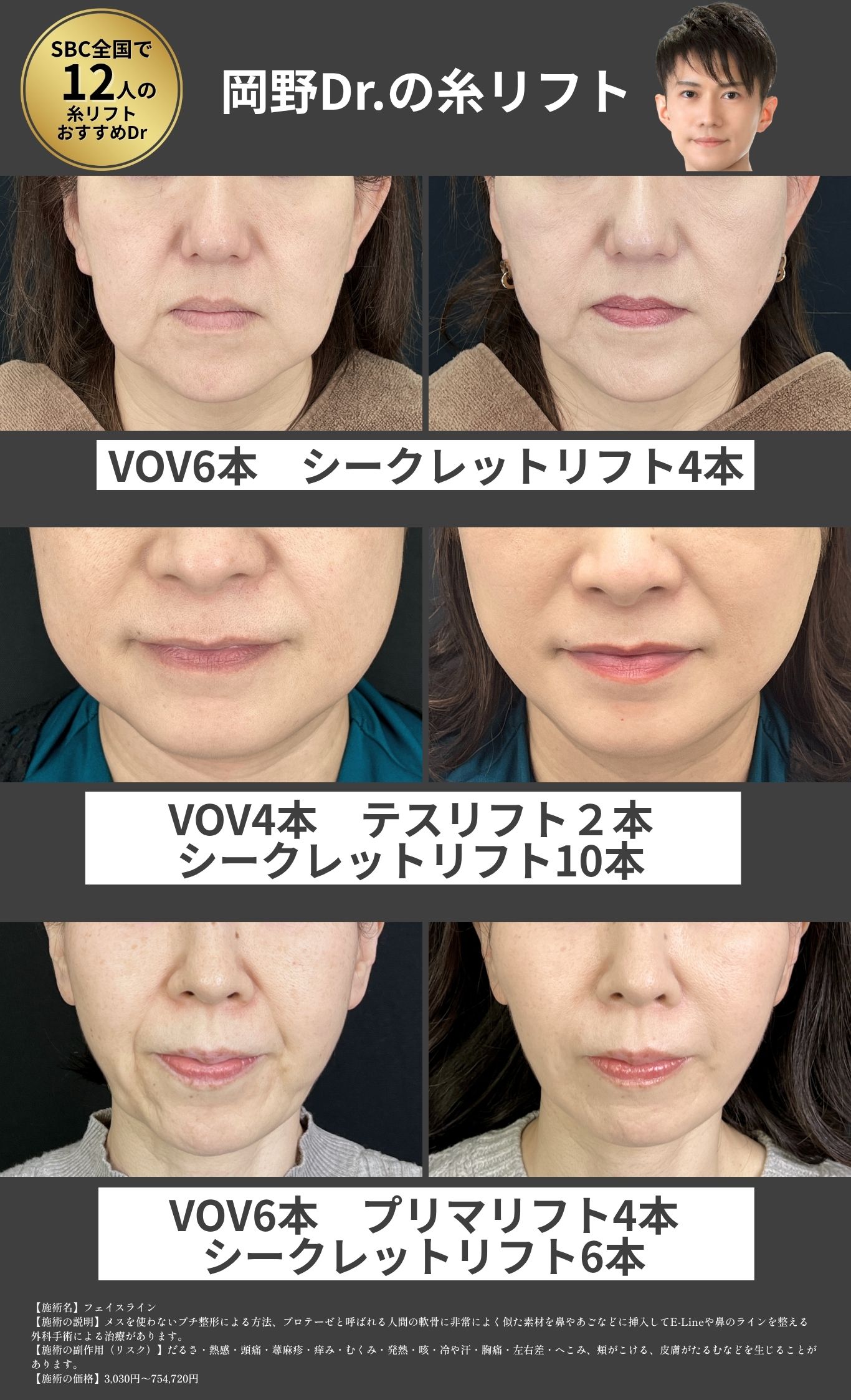 糸リフト(プリマリフト・VOV・シークレット)の症例写真 湘南美容クリニック久留米院