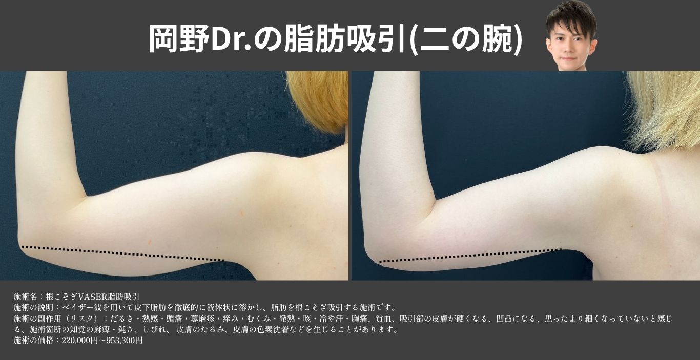 二の腕のベイザー脂肪吸引の症例写真 湘南美容クリニック久留米院