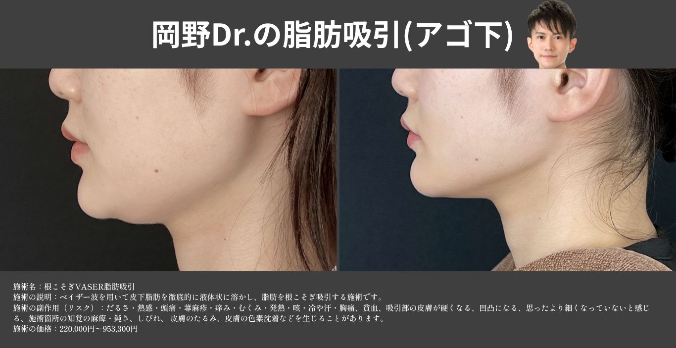 顔・アゴ下のベイザー脂肪吸引の症例写真 湘南美容クリニック久留米院