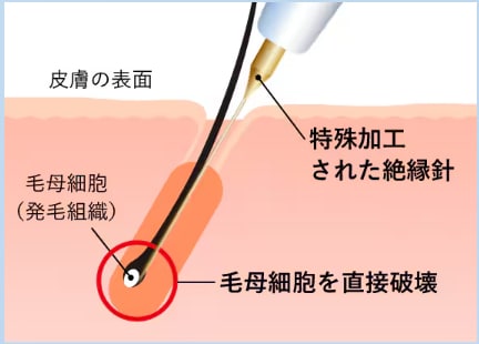 レーザーでは反応しない毛も1本ずつ確実に永久脱毛