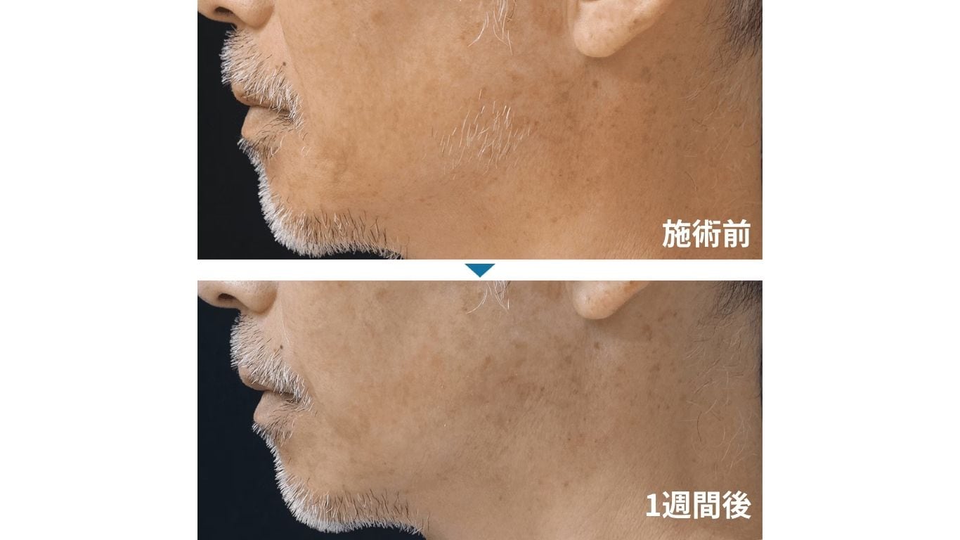 久留米】白髪や眉毛も永久脱毛！ニードル脱毛（医療針脱毛）徹底解説