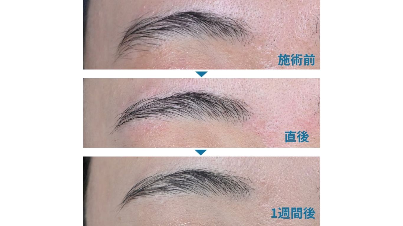 眉毛の症例