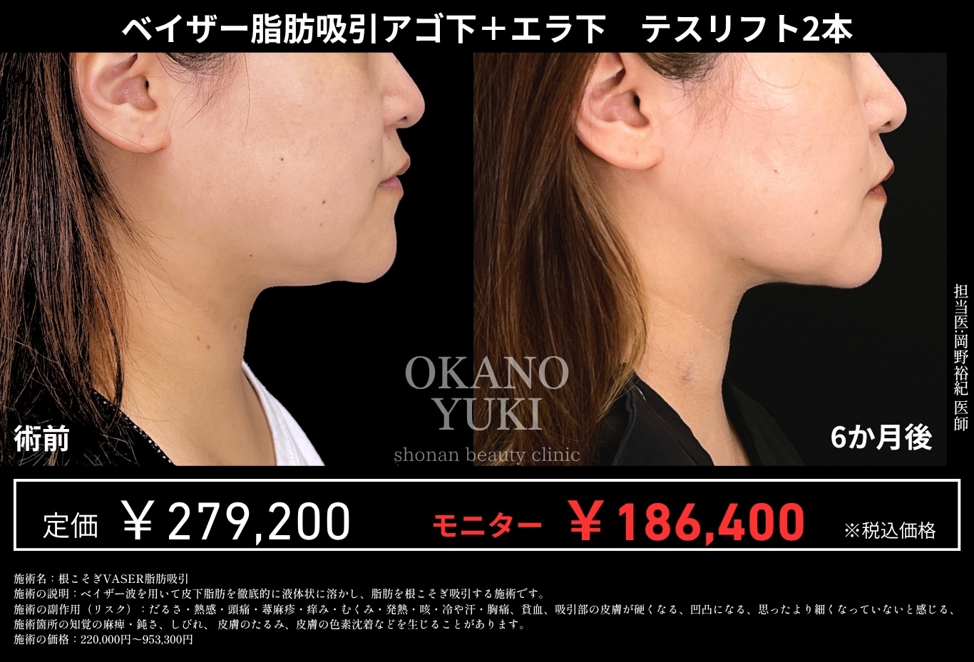 根こそぎ吸引×強力リフトアップで究極のVラインへ