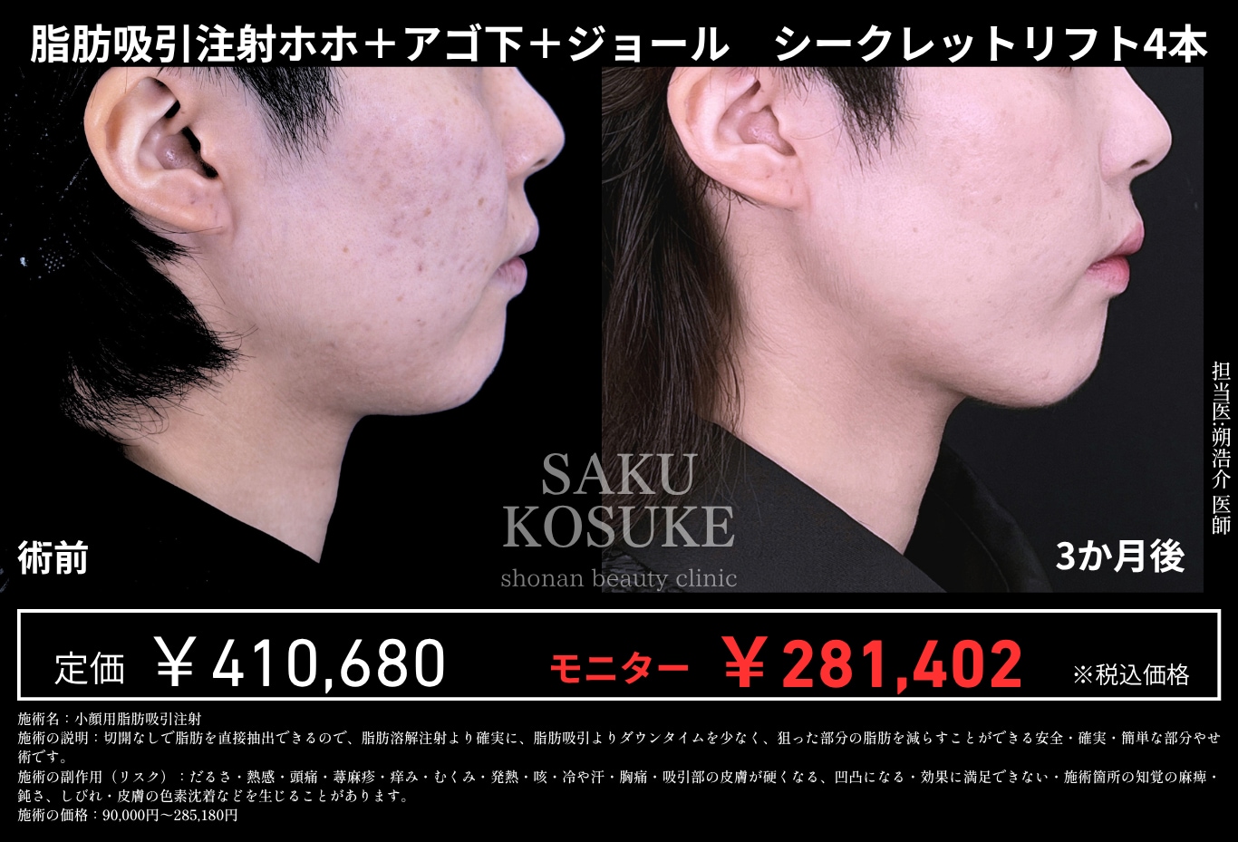 切開なし・ダウンタイム最小限で手軽に小顔を叶える