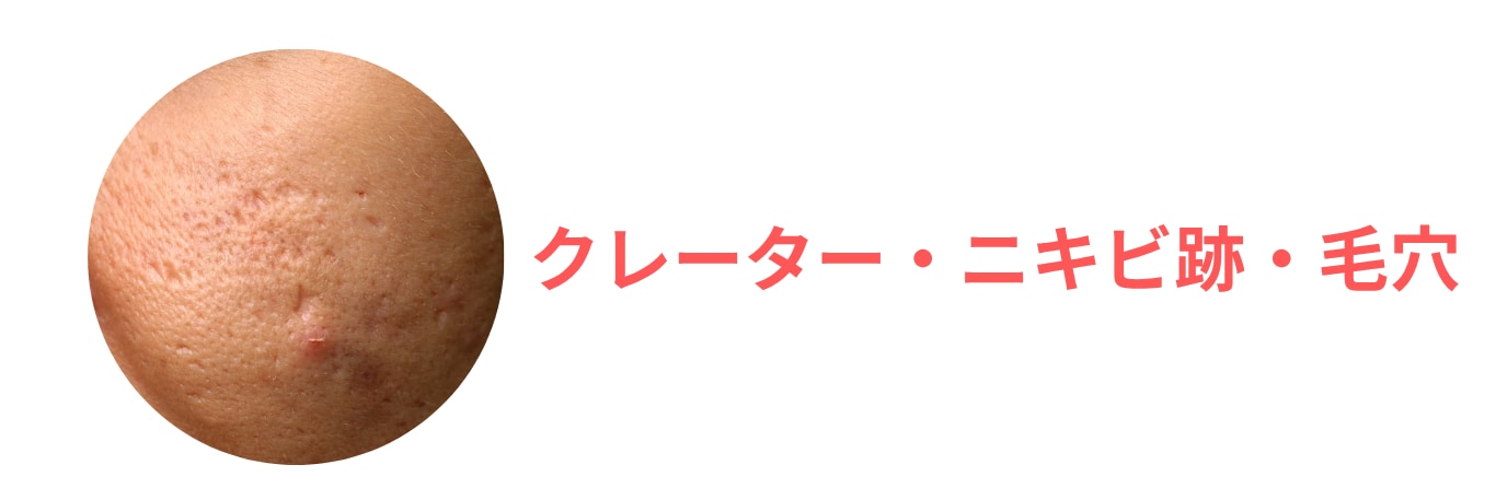 【凹凸改善】アクネスカーピコ（ピコフラクショナル）