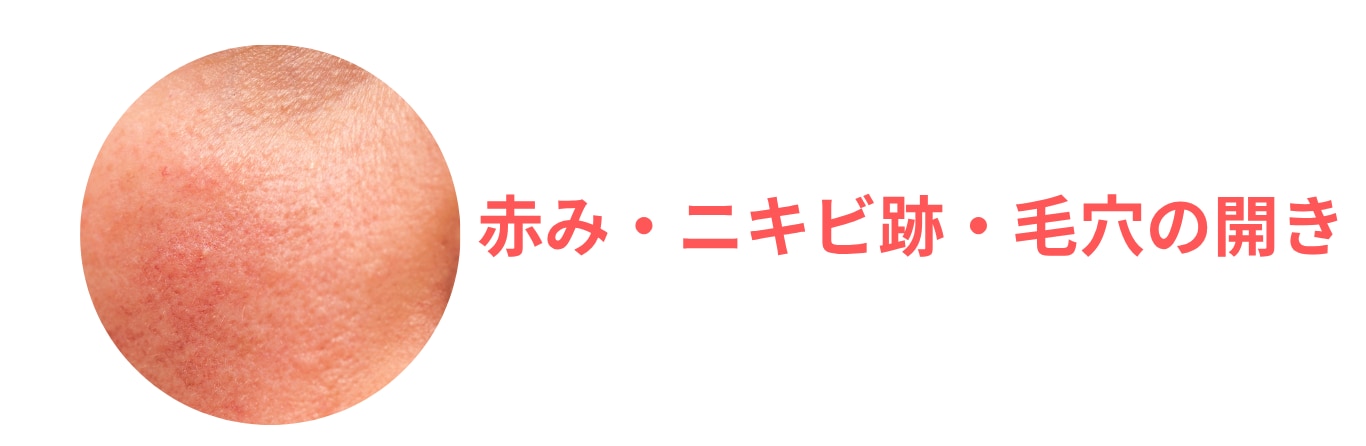 【肌質改善】シルファームX（RFマイクロニードル）