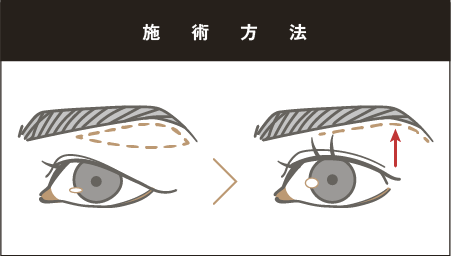施術方法は?