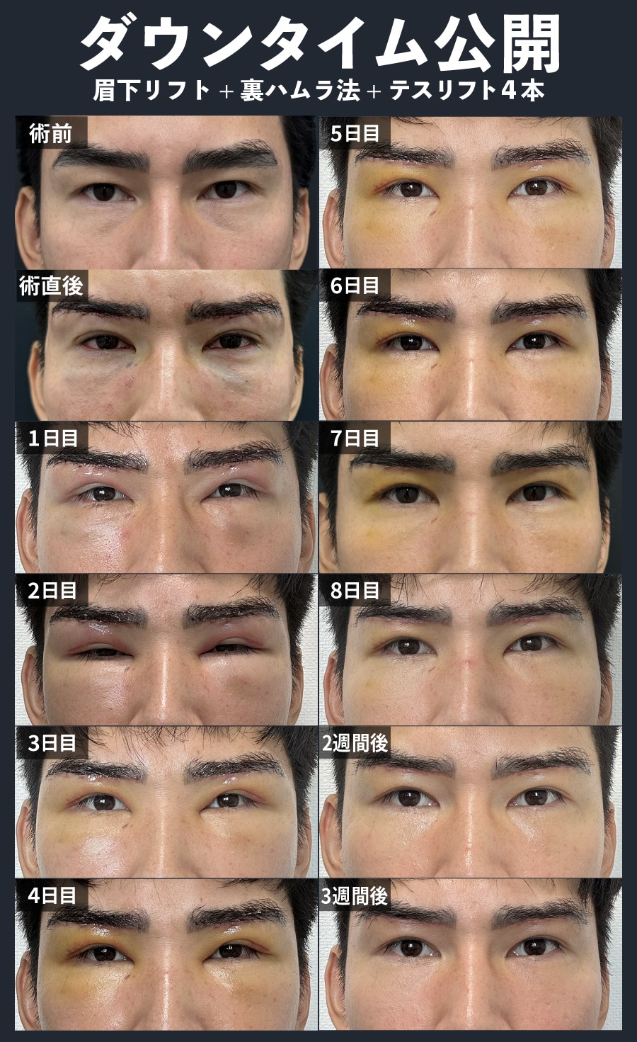 【眉下リフト・クマ取り治療】気になるダウンタイム公開！
