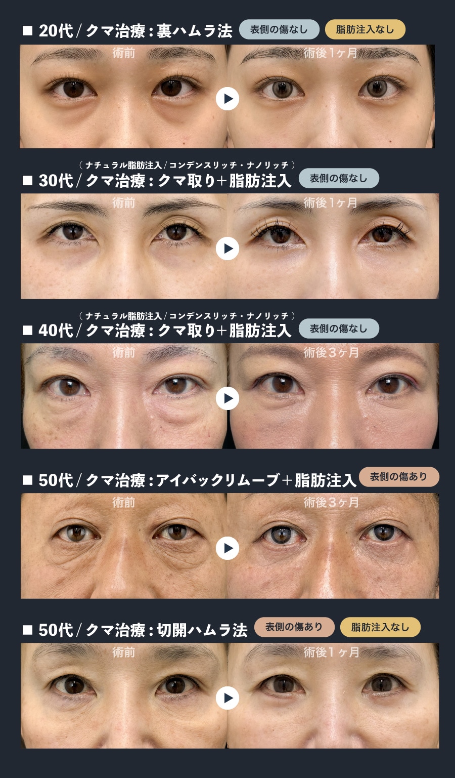 お疲れ顔解消！年代別【クマ取り治療】症例<br />
