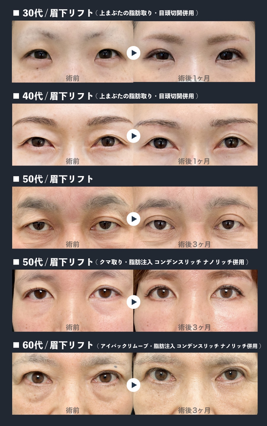 目元の若返り！年代別【眉下リフト】症例