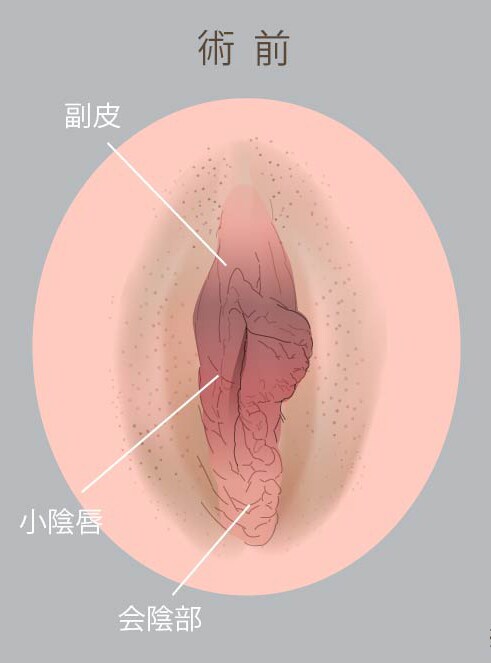 全体的に余剰皮膚の多かった女性器をスッキリさせた症例です。