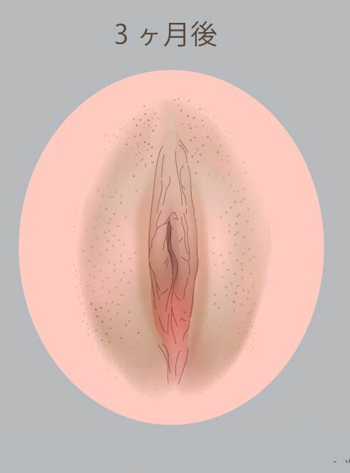 全体的に余剰皮膚の多かった女性器をスッキリさせた症例です。