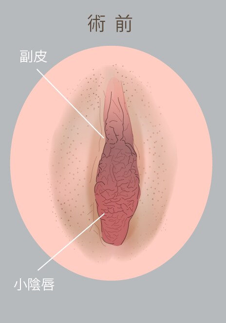 厚みがあり大きくはみ出ていた女性器をスッキリ除去しました。
