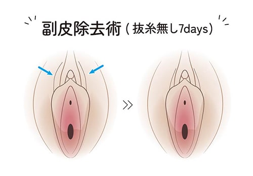 人気施術② 副皮除去術