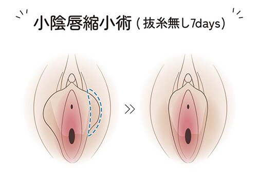 人気施術① 小陰唇縮小