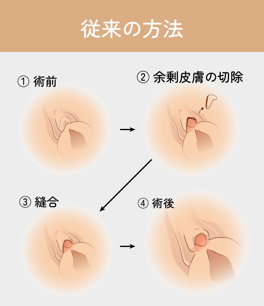 陰核包茎術の弱点