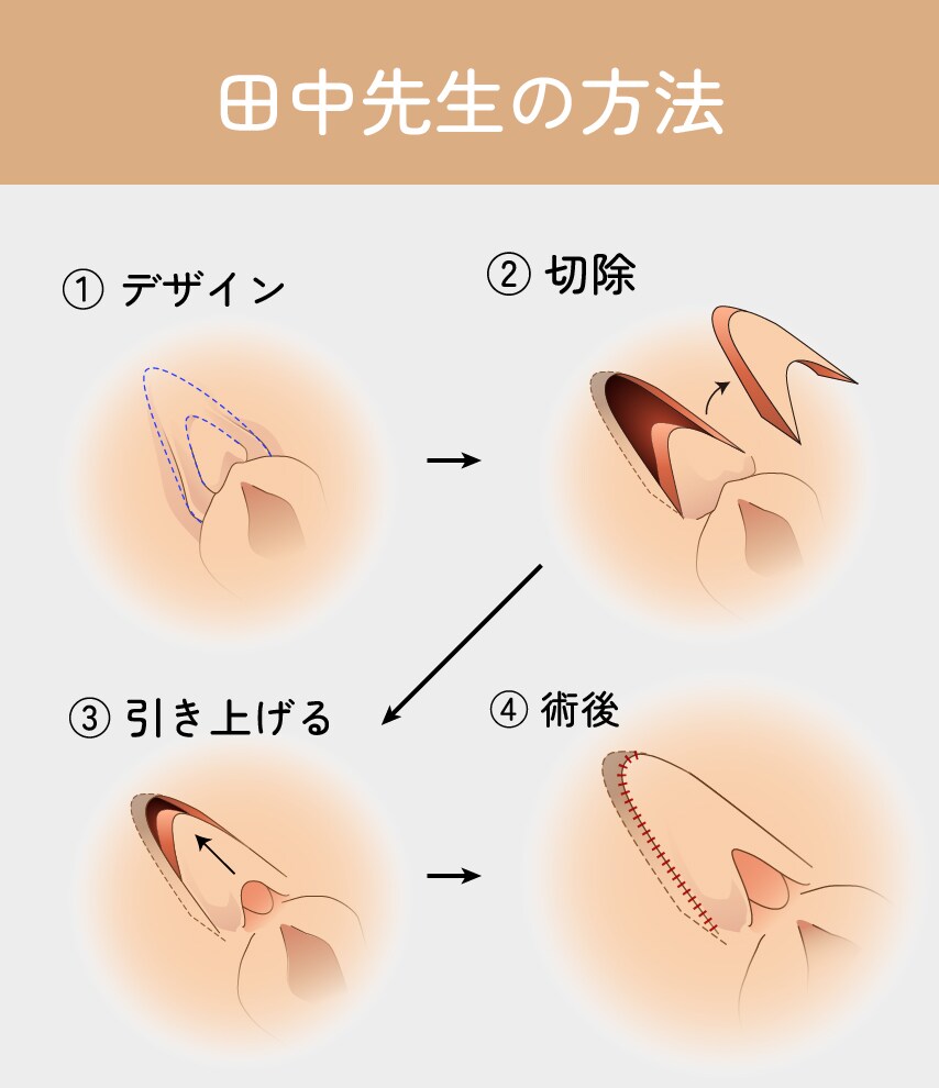田中永紅医師考案の陰核包茎術