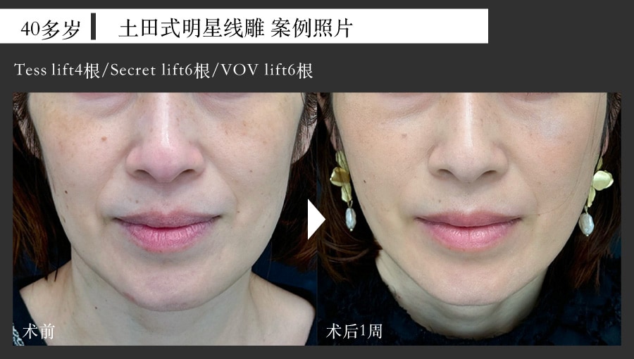 40岁女性 线雕案例照片