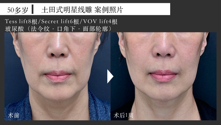 50岁女性 线雕提升案例照片<br />