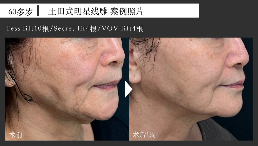 60岁女性 线雕提拉案例照片