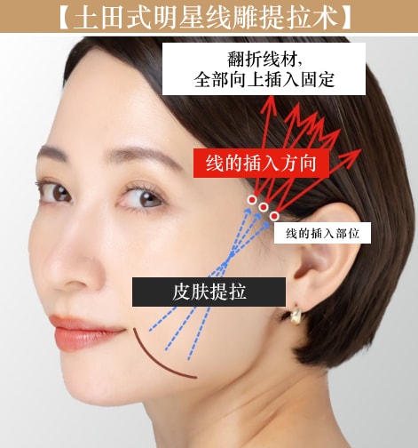 明星线雕的插入方法