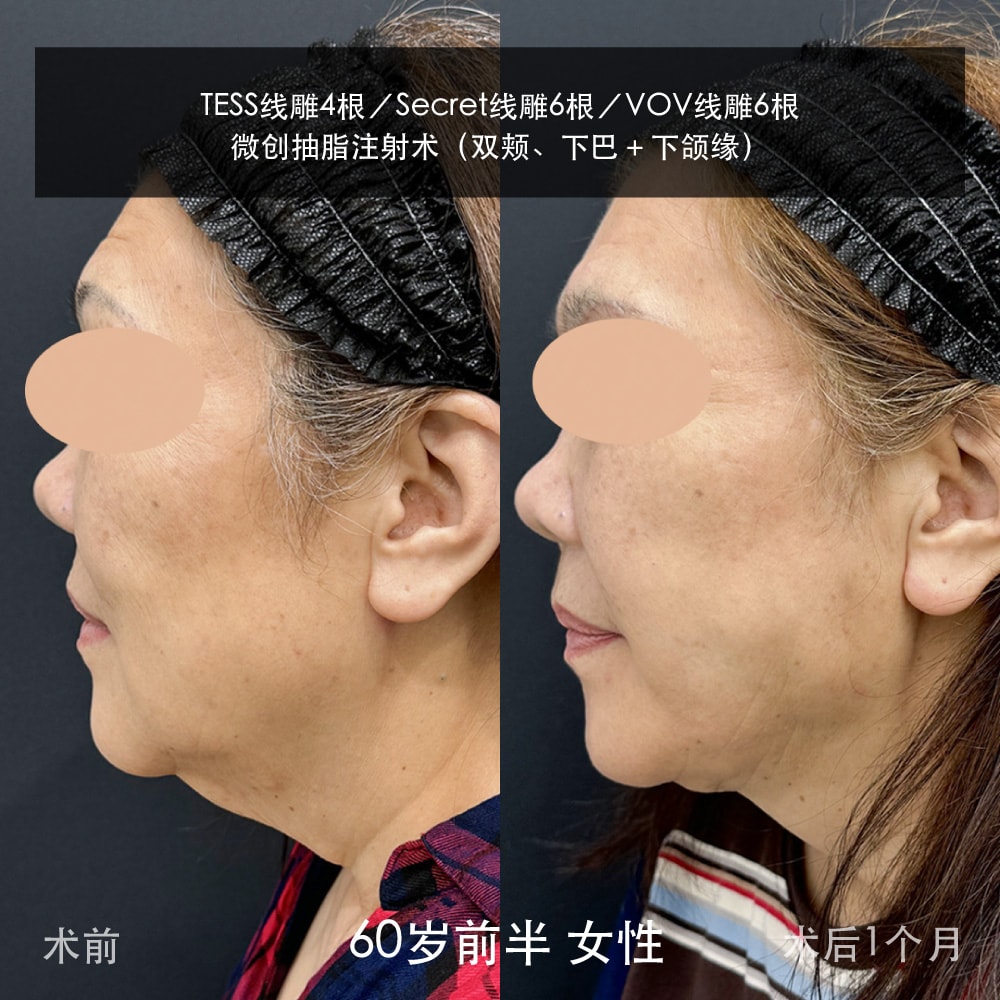 松弛＋脂肪，一次搞定！