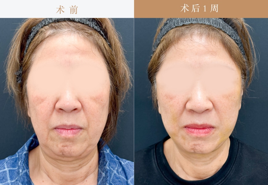 【 Tess lift 4根+Secret lift 6根+水润蛋白线提拉 80根】<br />