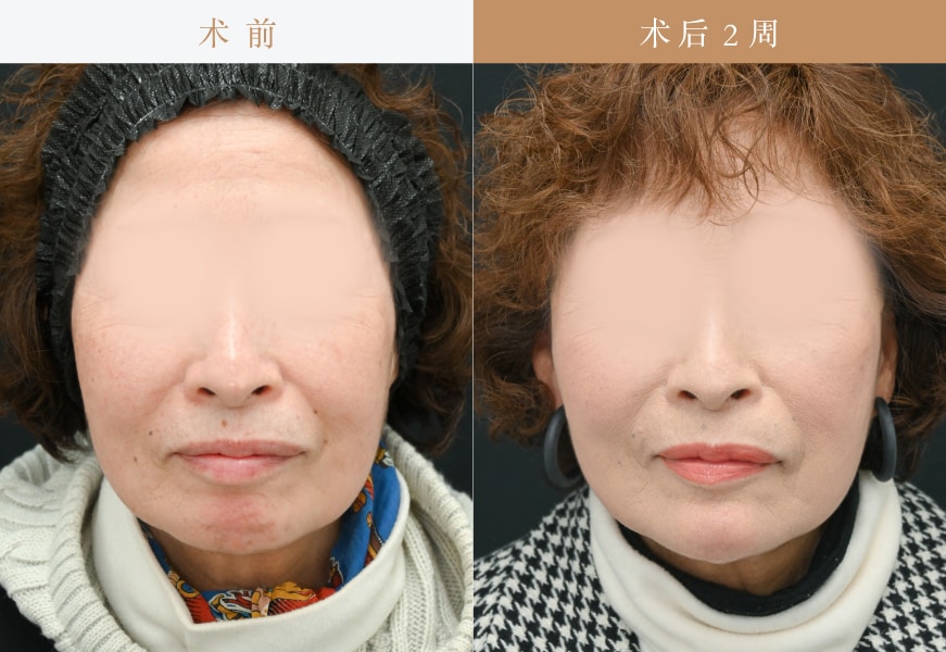 【Tess lift 6根+ Secret lift 6根+玻尿酸注射】<br />
