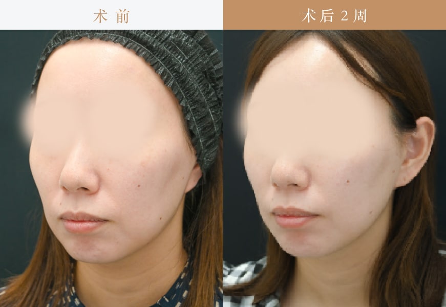 【Tess lift 4根 + Vov lift 6根】<br />